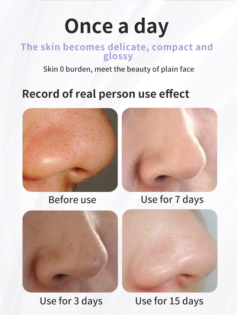 Electric Microbubble Blackhead Remover Vacuum 3