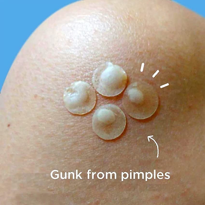 Hydrocolloid Acne Patch Amazing Pimple for Zits Whiteheads 4