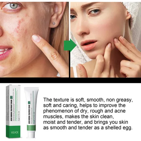 EELHOE Acne & Blemish Cream Lightens Blemishes Brightens