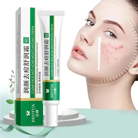 acne treatment cream